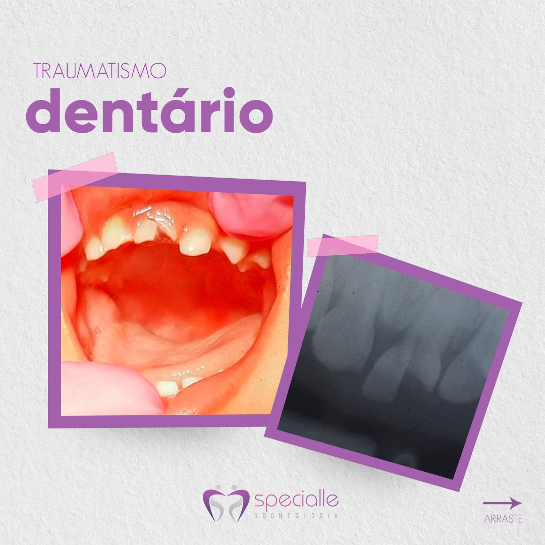 TRAUMATISMO DENTÁRIO
